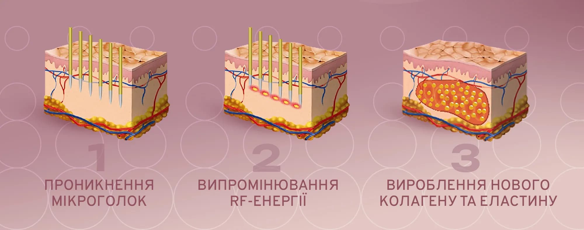 Апарат використовує насадку з тоненькими мікроголками, які входять у шкіру на глибину до 3,5 мм, створюючи контрольовані мікропошкодження в дермі, що запускає вироблення власного колагену та еластину.